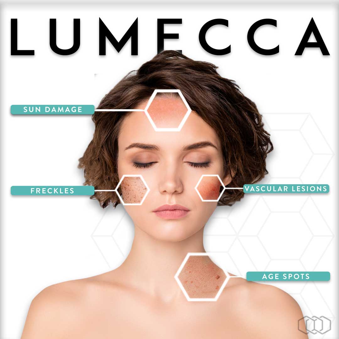 infographic for Lumecca IPL laser photofacial showing sun damage, freckles, vascular lesions, and age spots