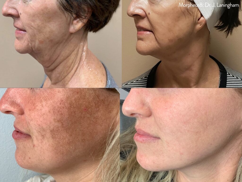 Morpheus8 microneedling before and after