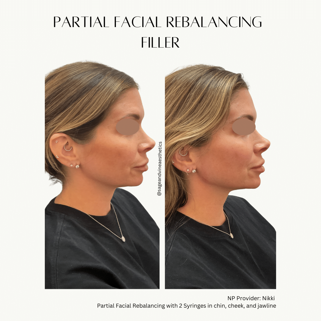 Before and After Image: Facial Filler – Rebalancing - right-side