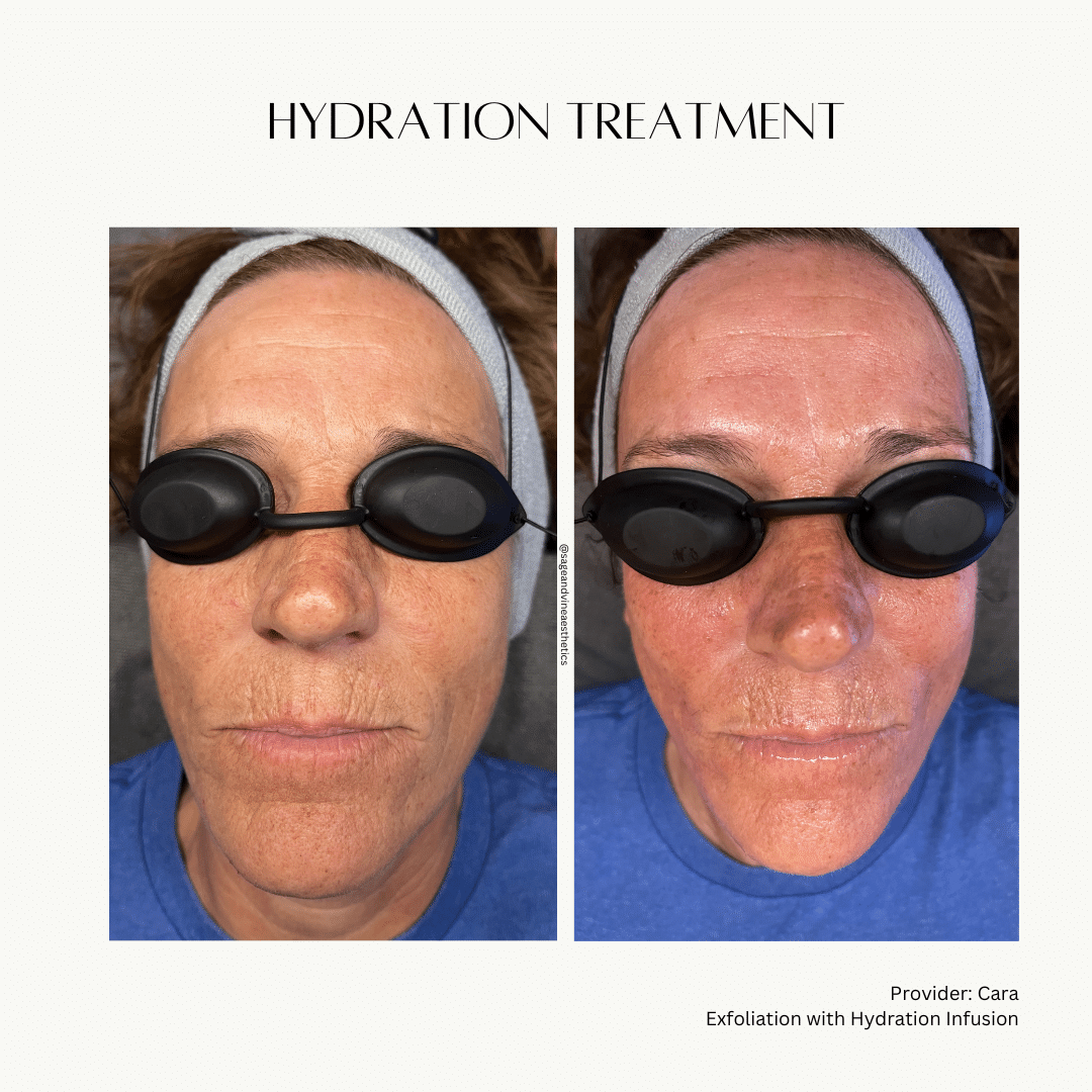 Before and After Image: HydraFacial - front