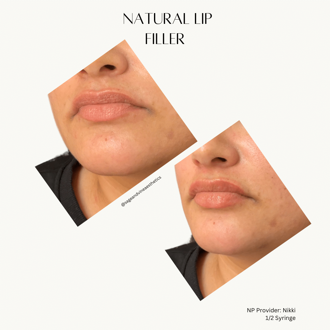 Before and After Image: Lip Filler - front
