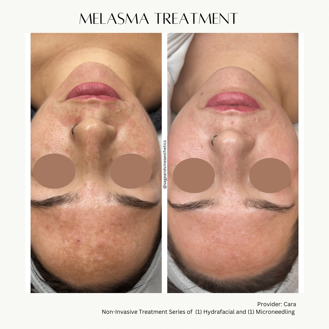 Before and After Image: Melasma – Microneedling - other
