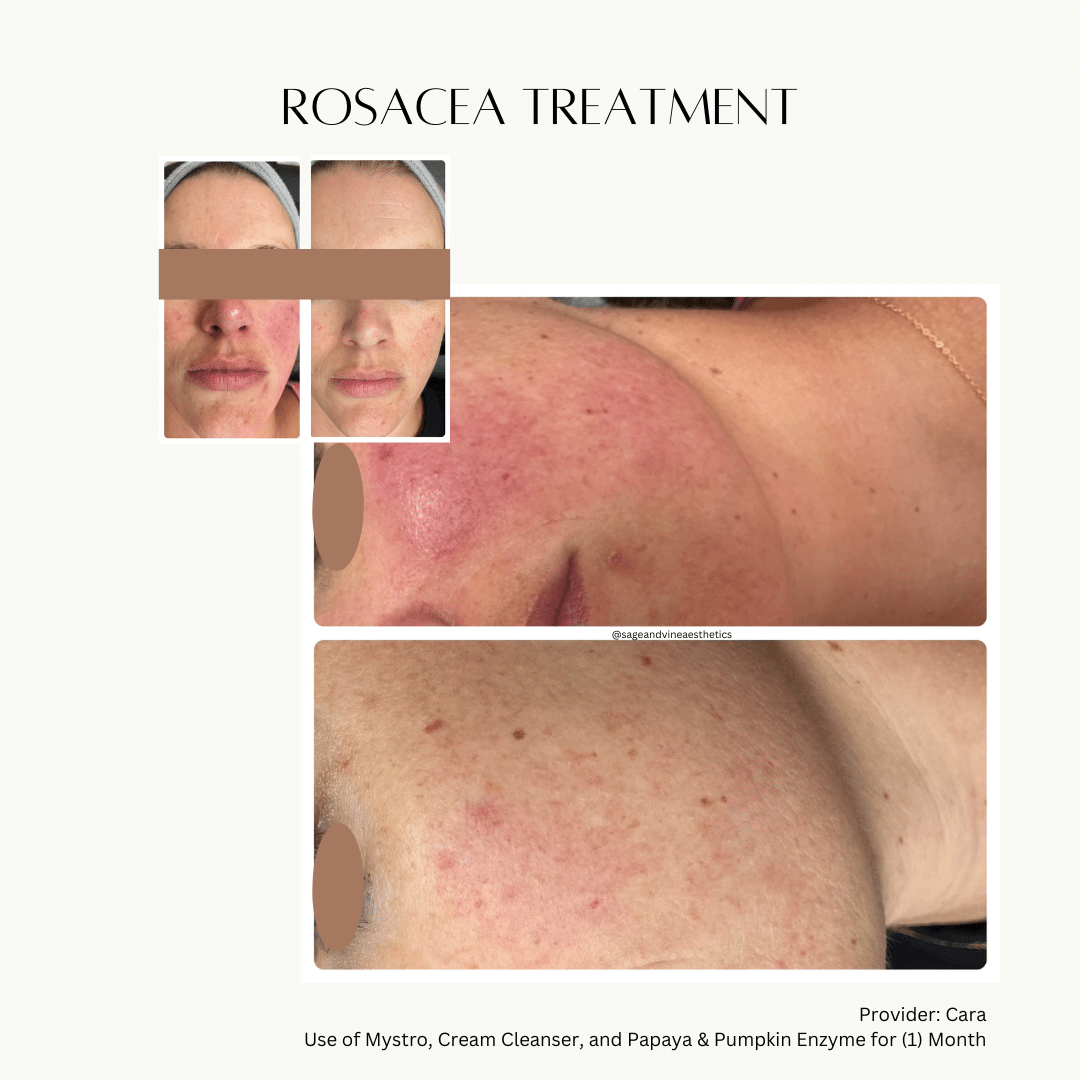 Before and After Image: Rosacea Facial - front