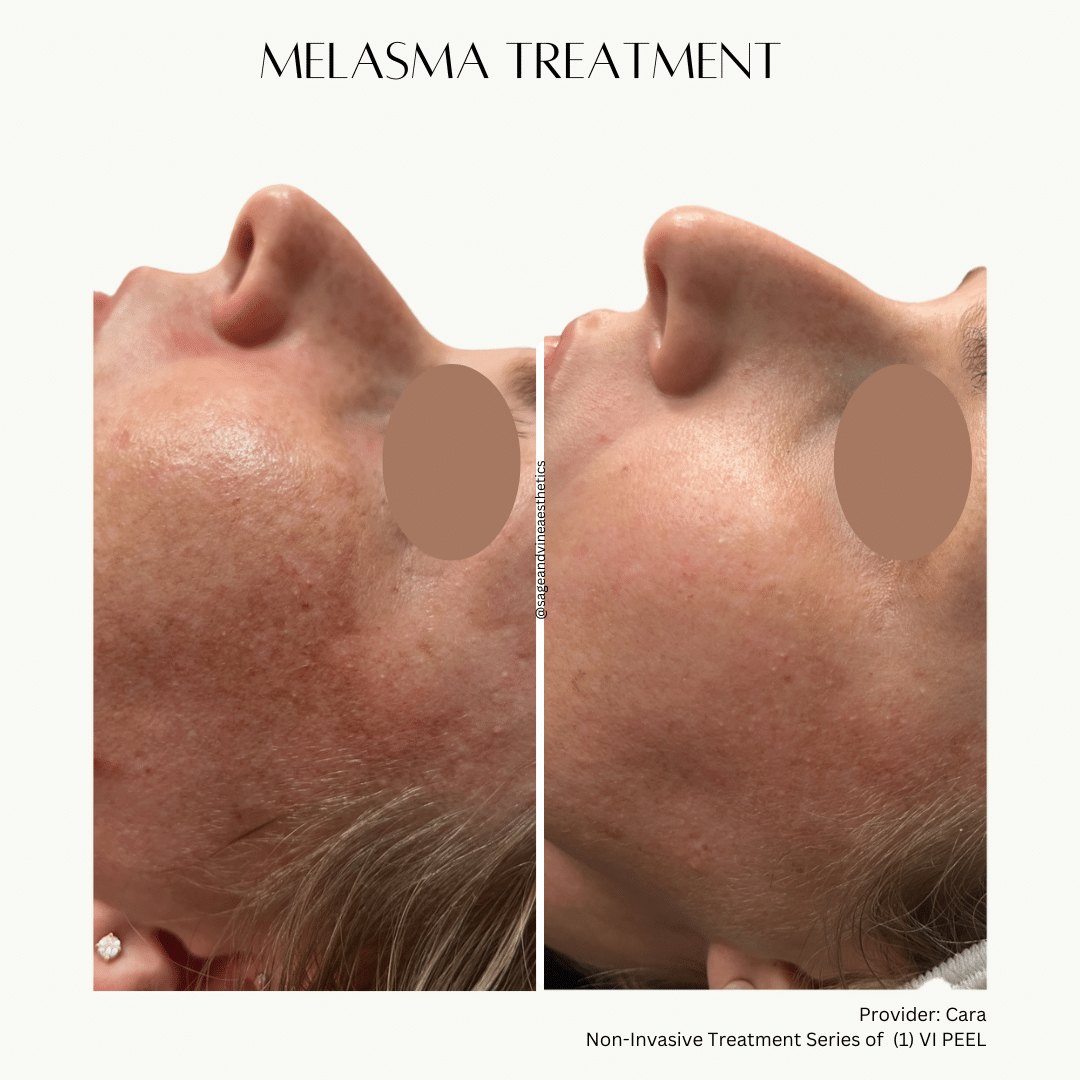 Before and After Image: VI Peel – Melasma - other