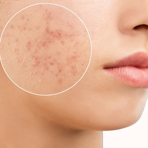 xr:d:DAFU8Qn2zvc:3,j:43779221208,t:22121617 Acne Bootcamp in Richmond