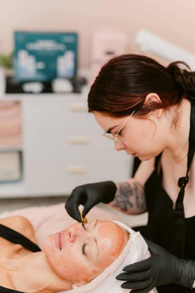 Chemical Peels Richmond, VA