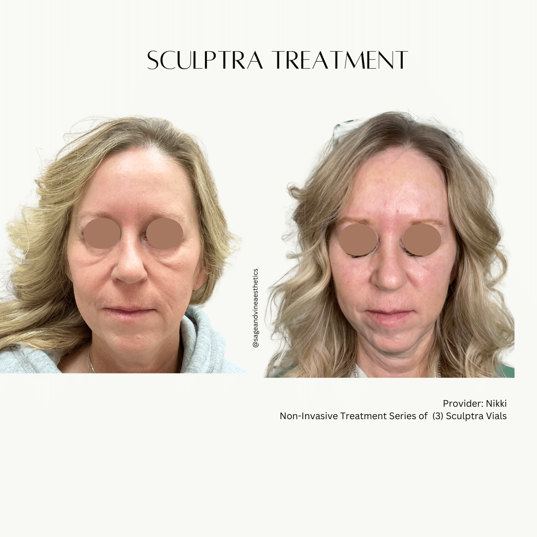 Before and After Image: Sculptra Treatment - front