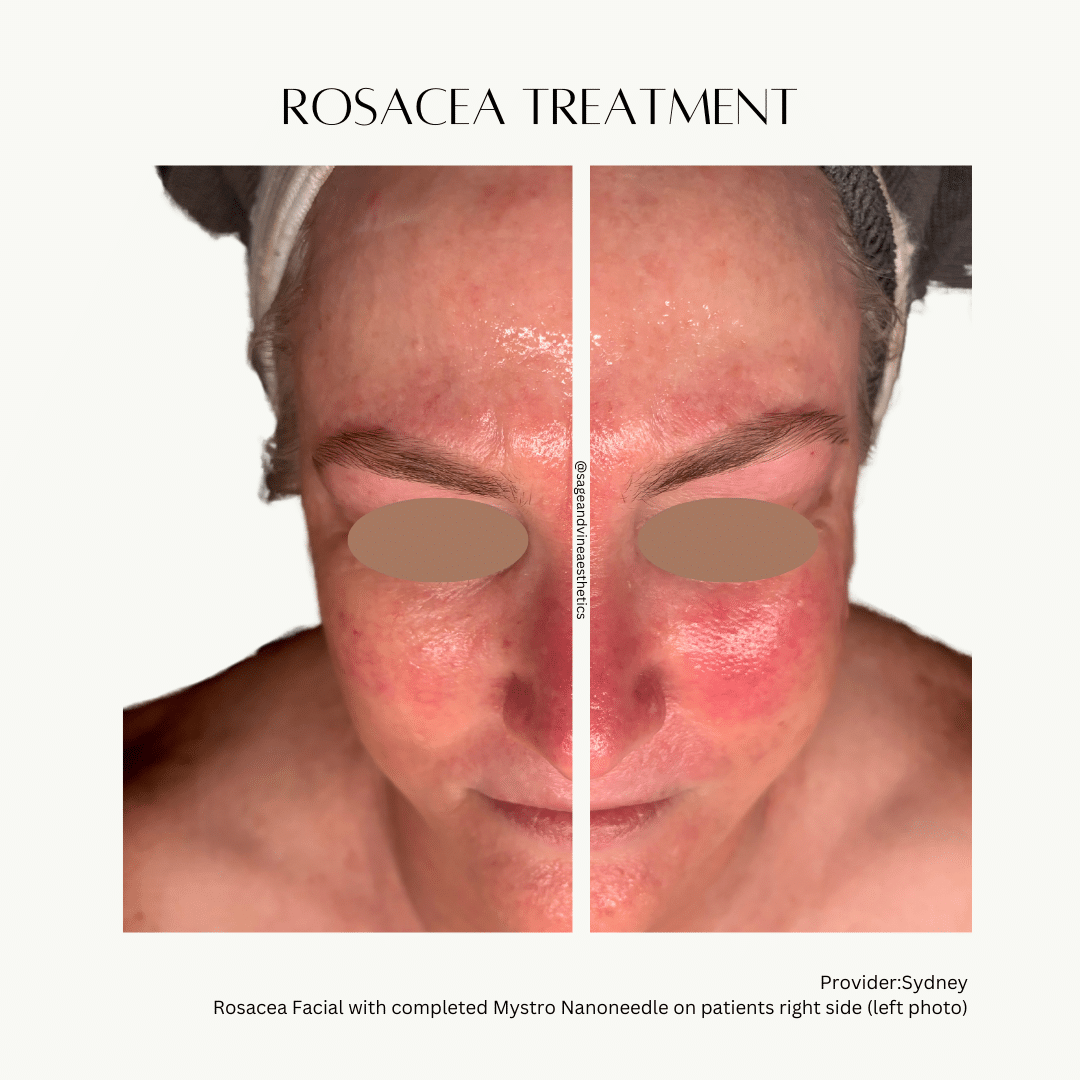 Before and After Image: Rosacea Treatment - front