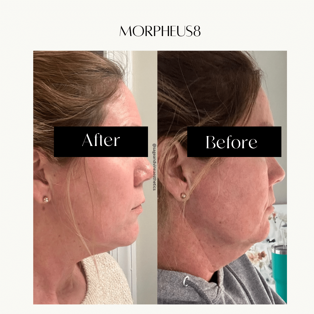 Before and After Image: Morpheus8 - right-side