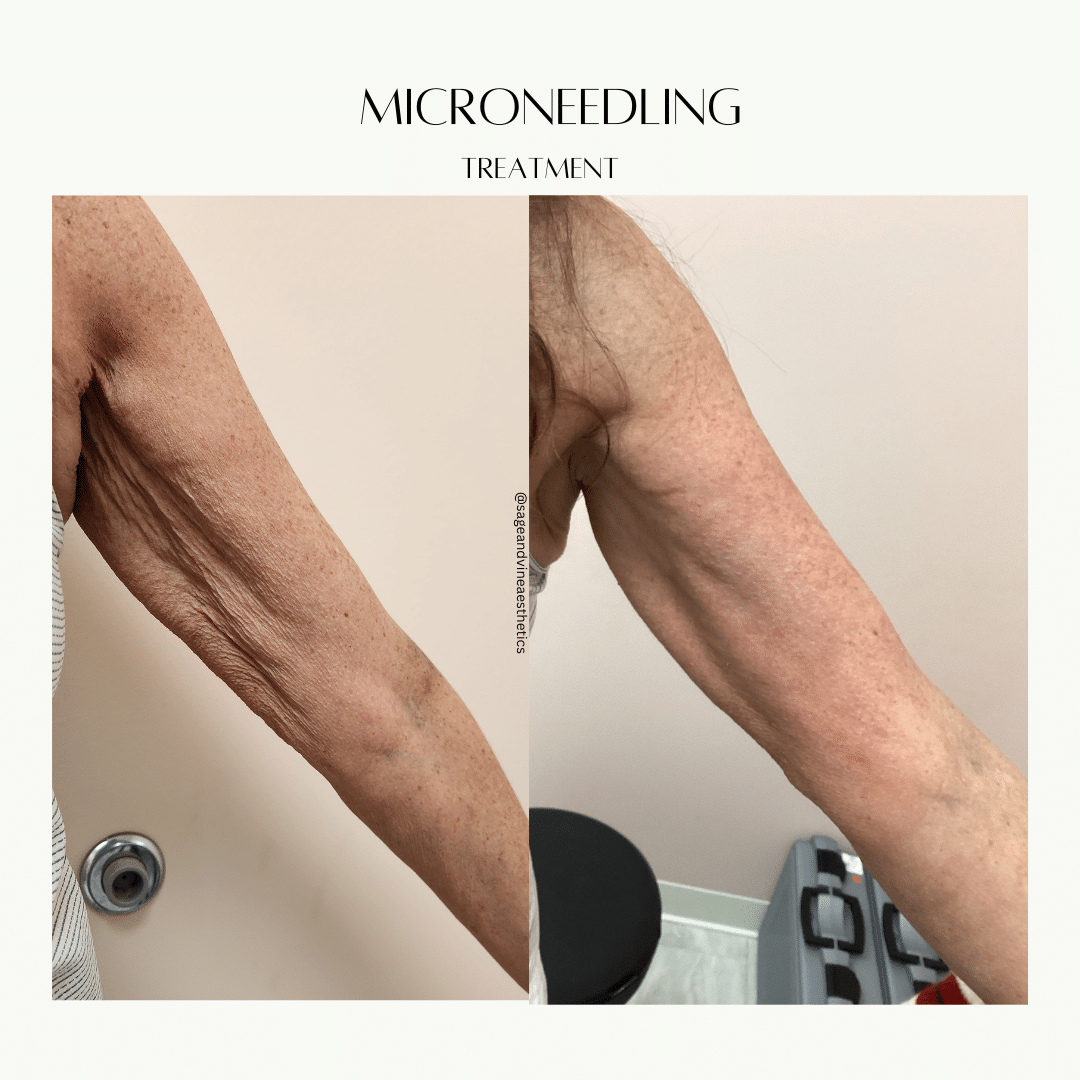 Before and After Image: Microneedling - front