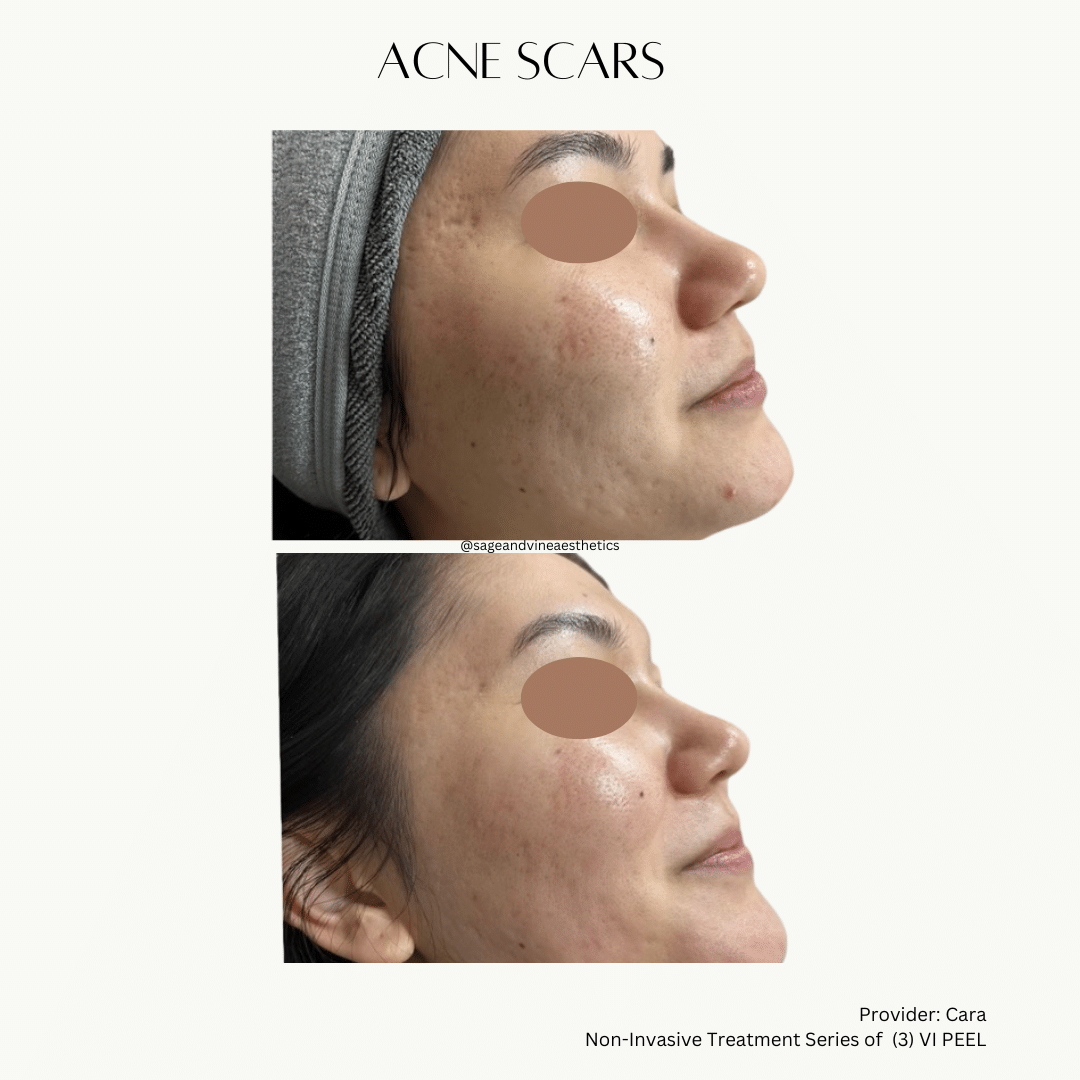 Before and After Image: Acne Scars - right-side