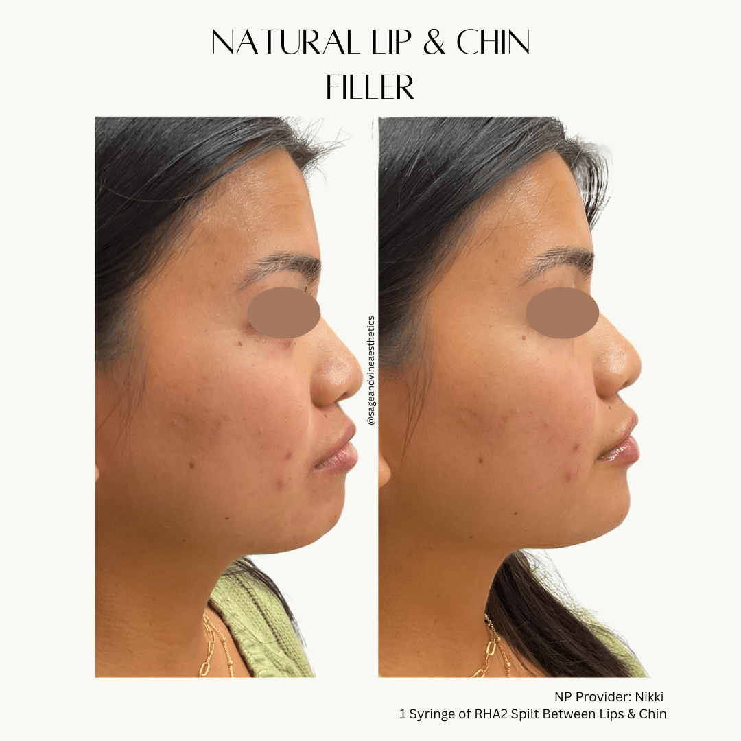 Before and After Image: Natural Lip & Chin Filler - right-side