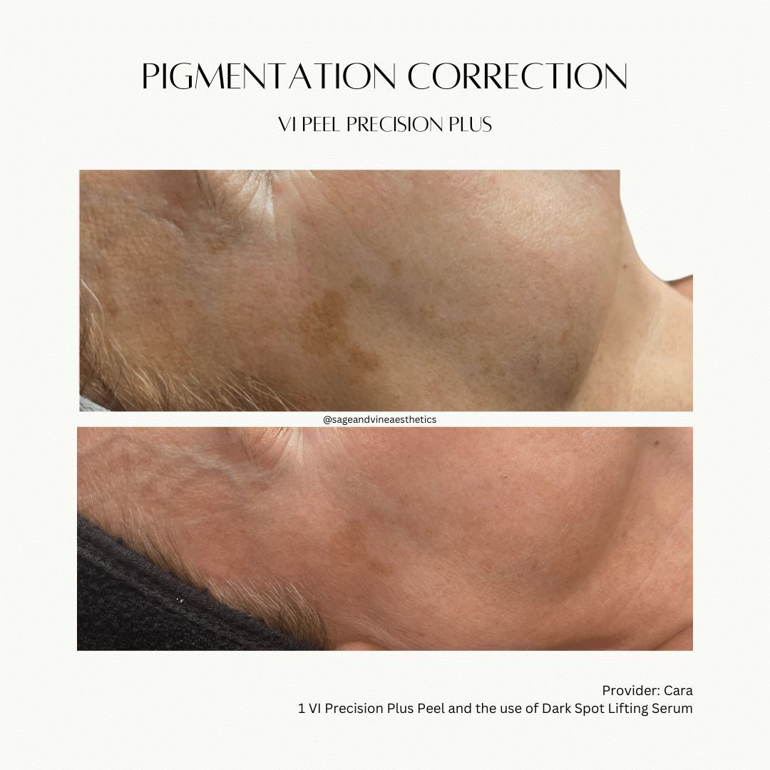 Before and After Image: Pigmentation Correction - front