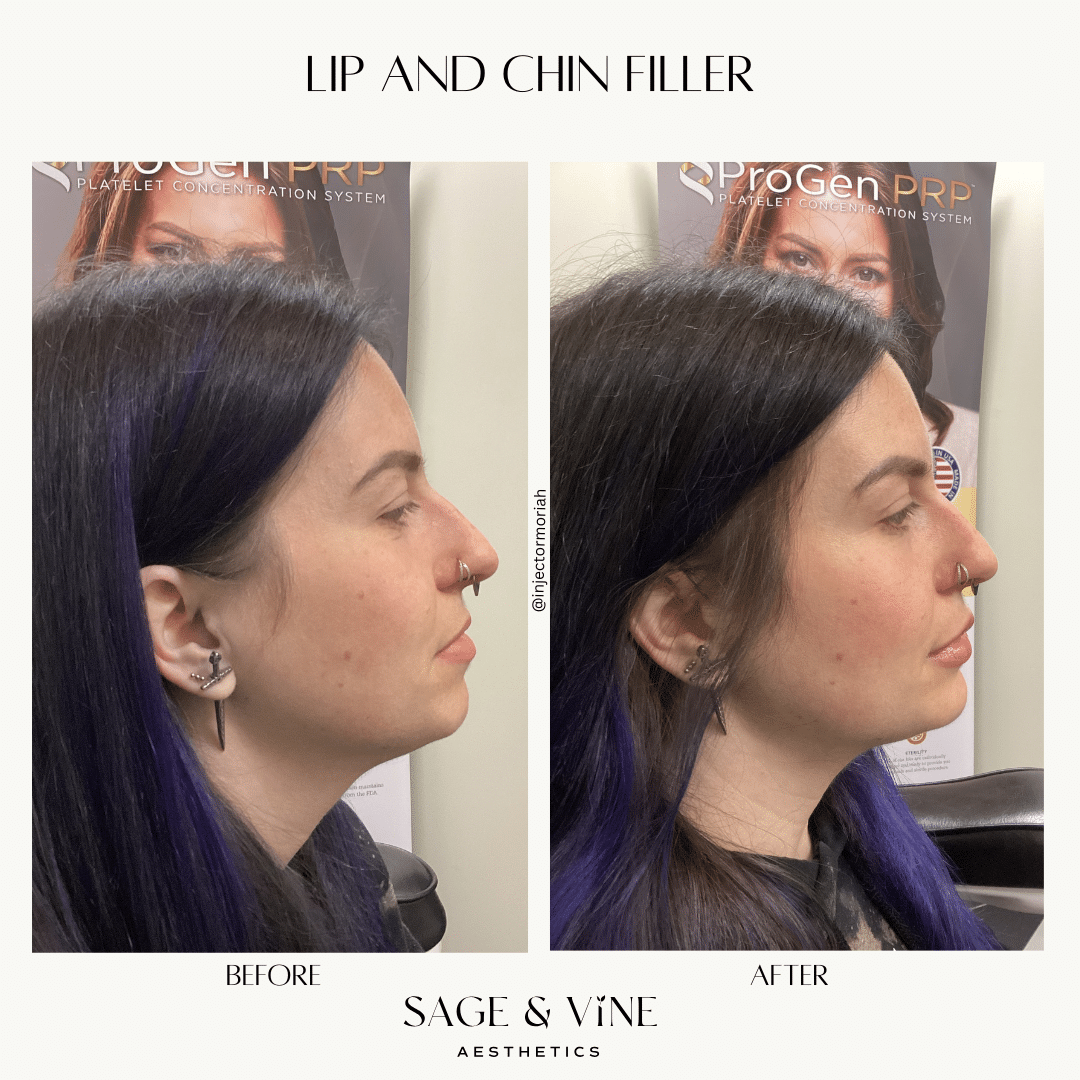 Before and After Image: Cheek, Chin, & Lip Filler - right-side