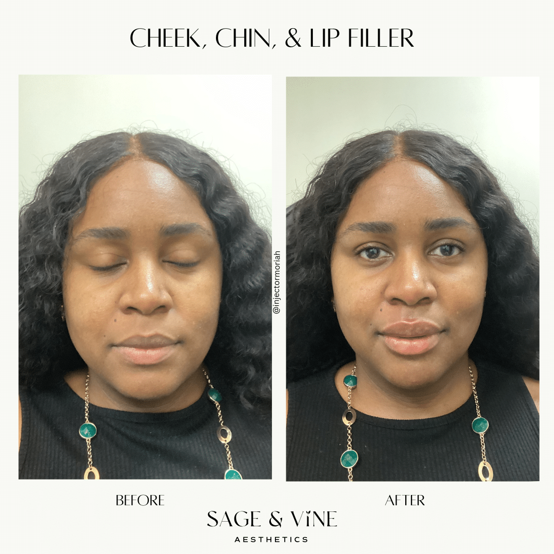 Before and After Image: Cheek, Chin, & Lip Filler - front