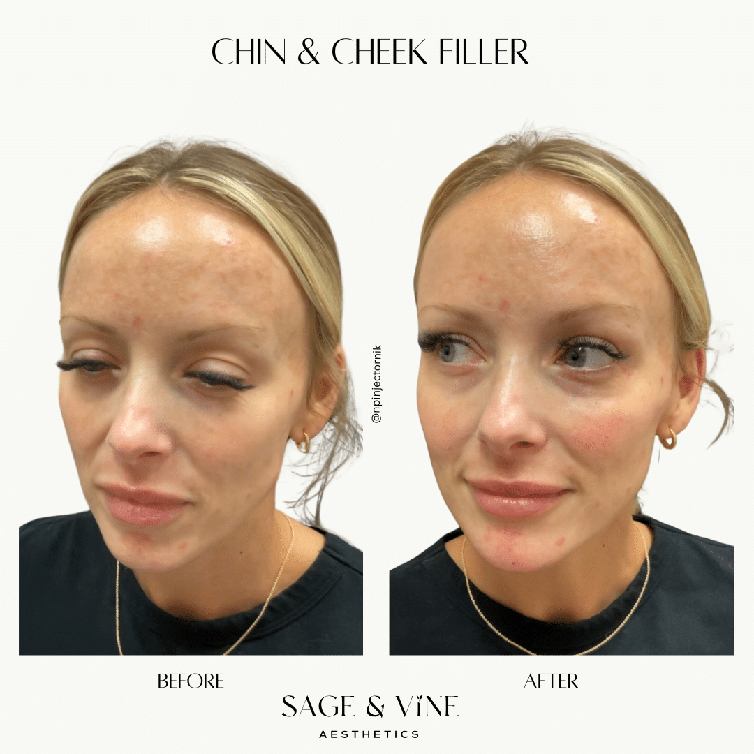 Before and After Image: Chin and Cheek Filler - front