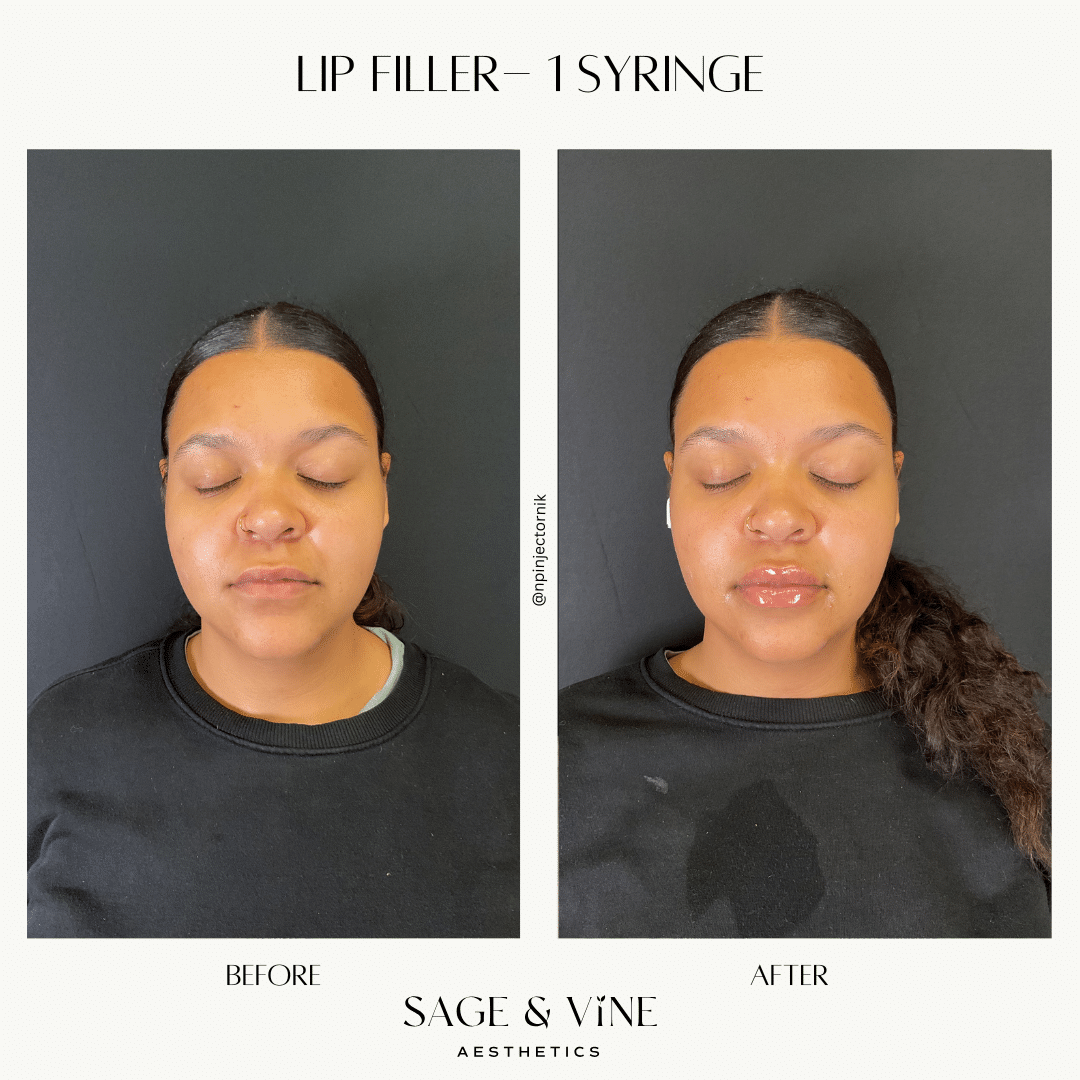 Before and After Image: Lip Filler, 1 Syringe - front