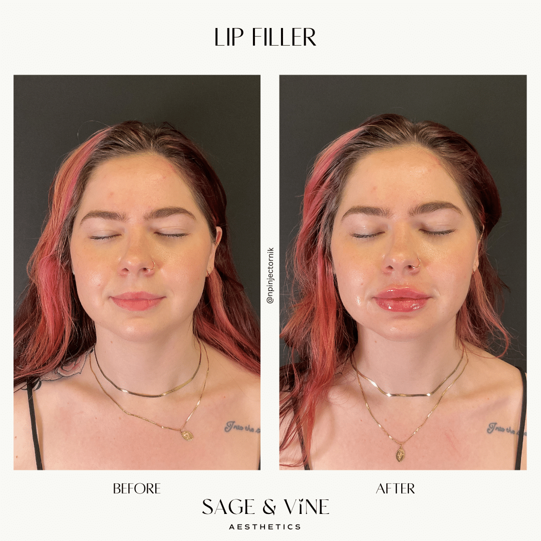Before and After Image: Lip filler, 1 syringe - front