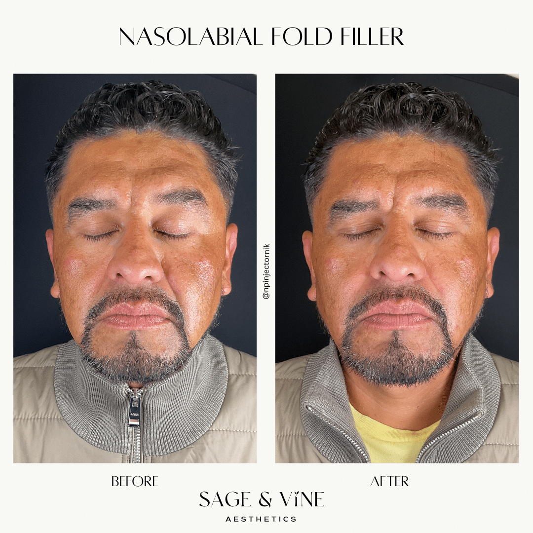 Before and After Image: Lip Filler, 1 Syringe - front