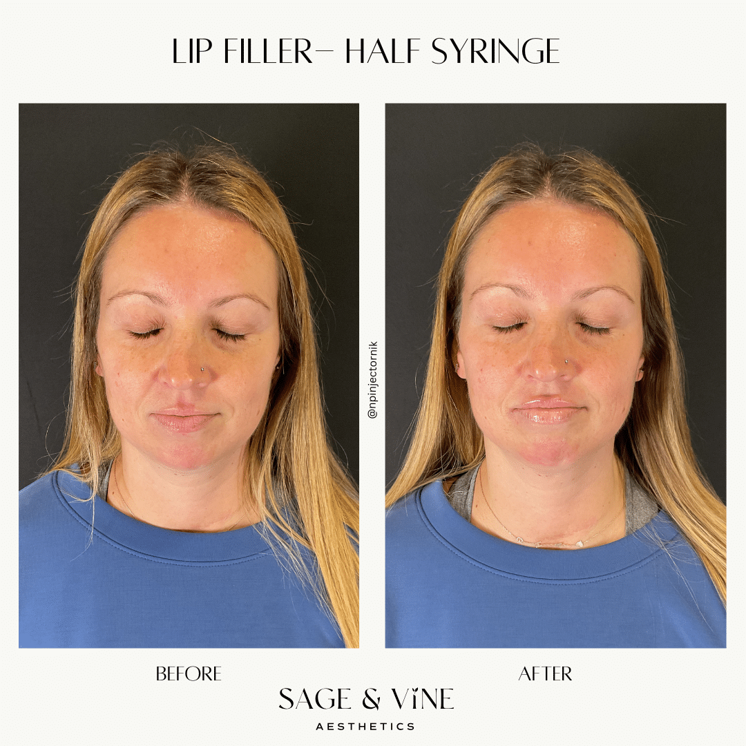 Before and After Image: Lip Filler, 1 Syringe - front