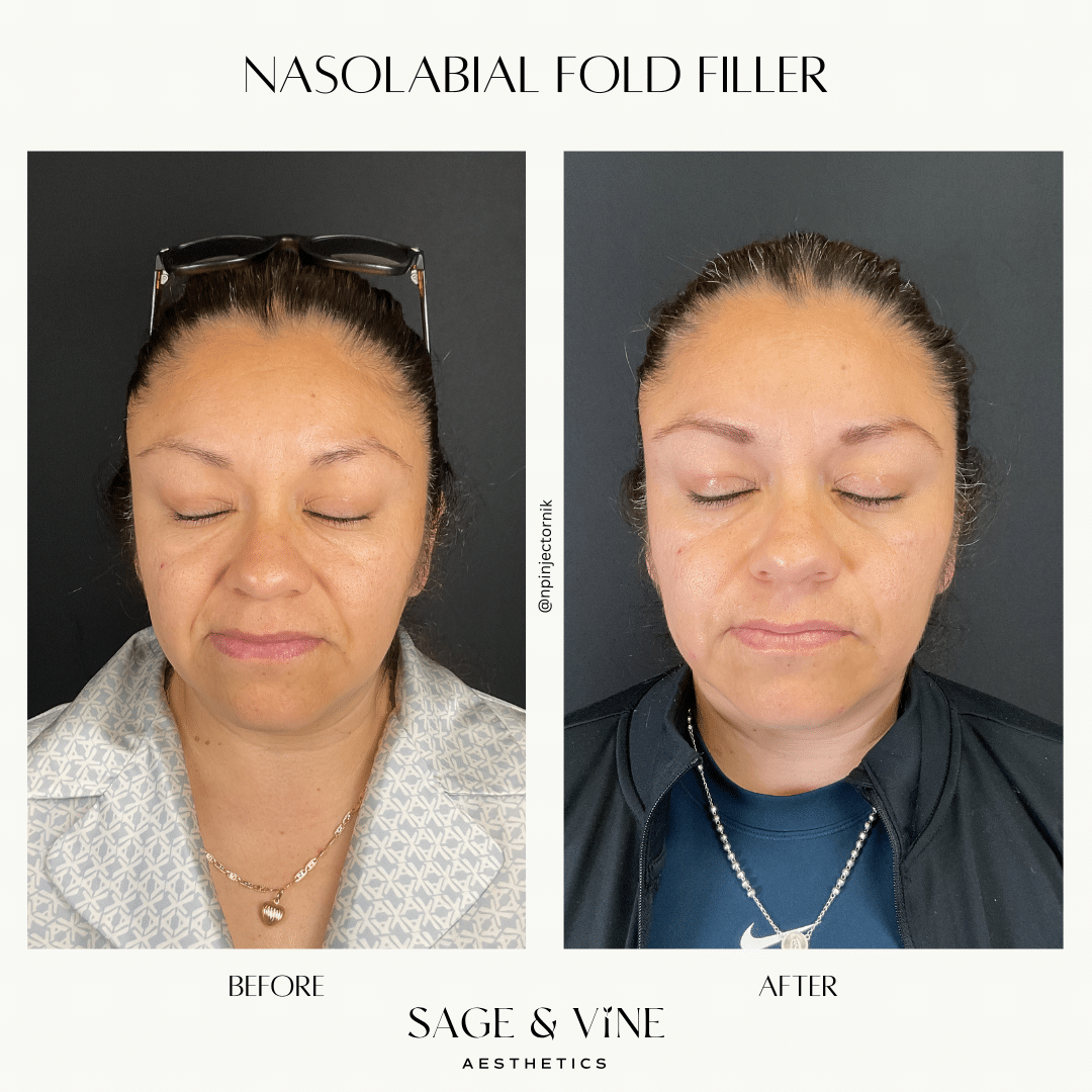 Before and After Image: Lip Filler, 2 Syringes - front