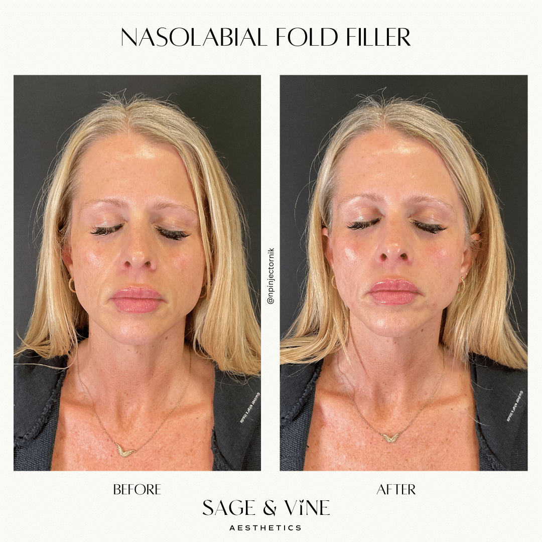 Before and After Image: NLF Filler - front