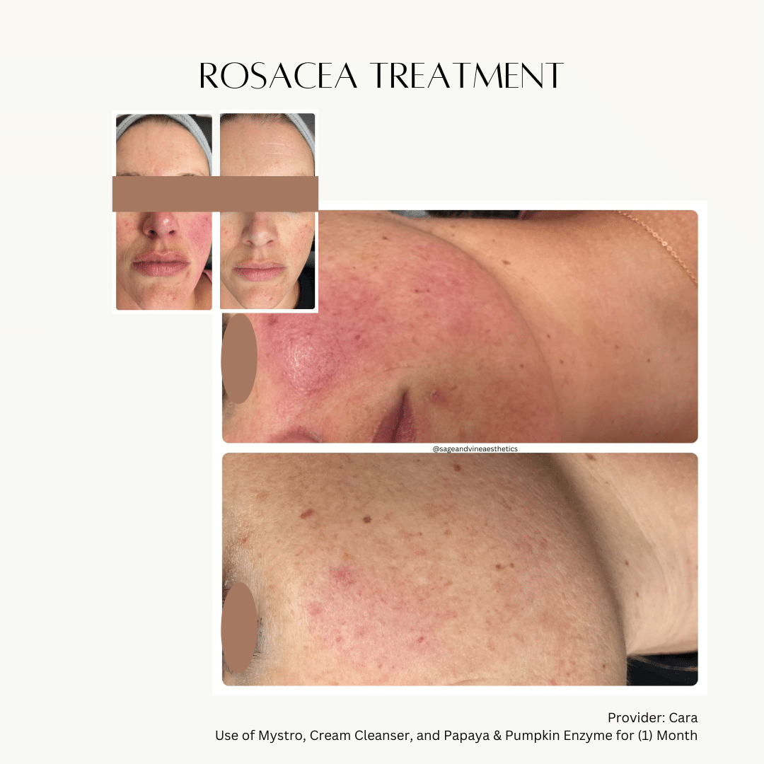 Before and After Image: Rosacea Treatment - front