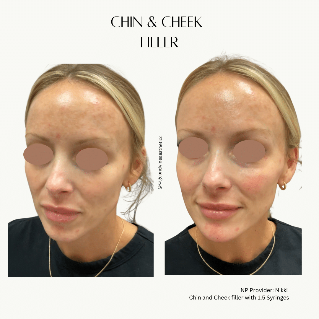 Before and After Image: Chin & Cheek Filler - front