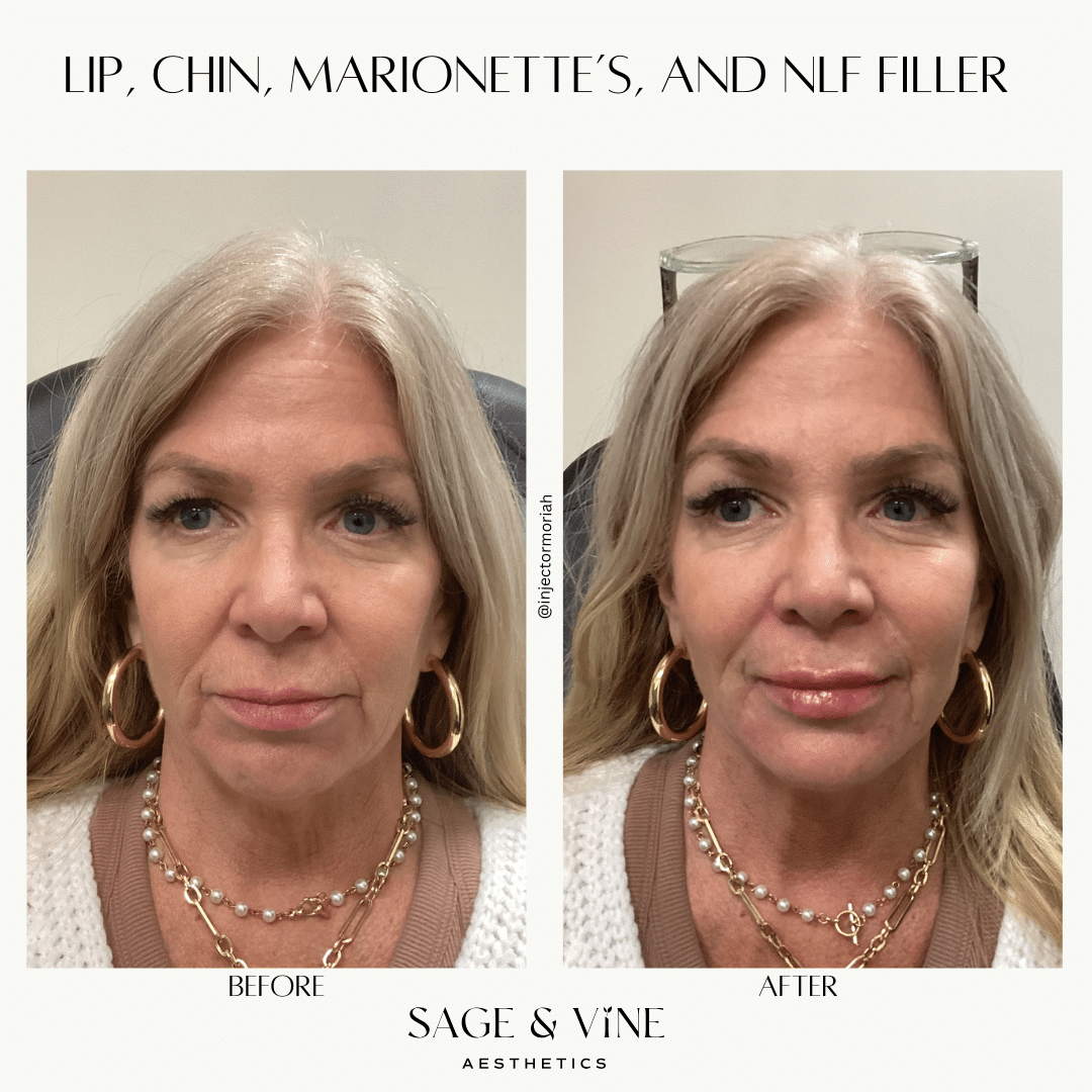 Before and After Image: Lip, Chin, Marionettes, and NLF Filler - front