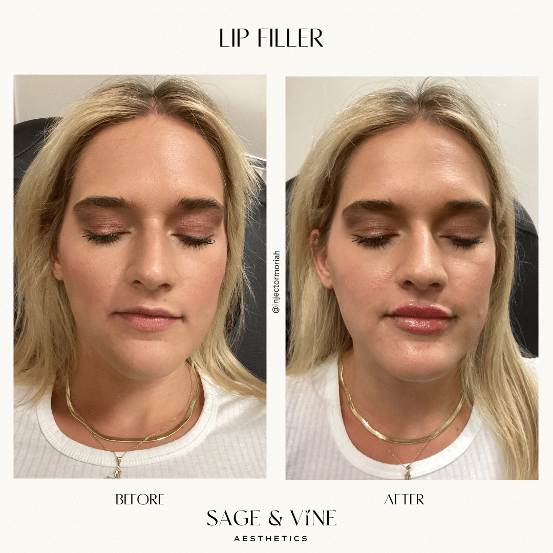 Before and After Image: Lip Filler - front