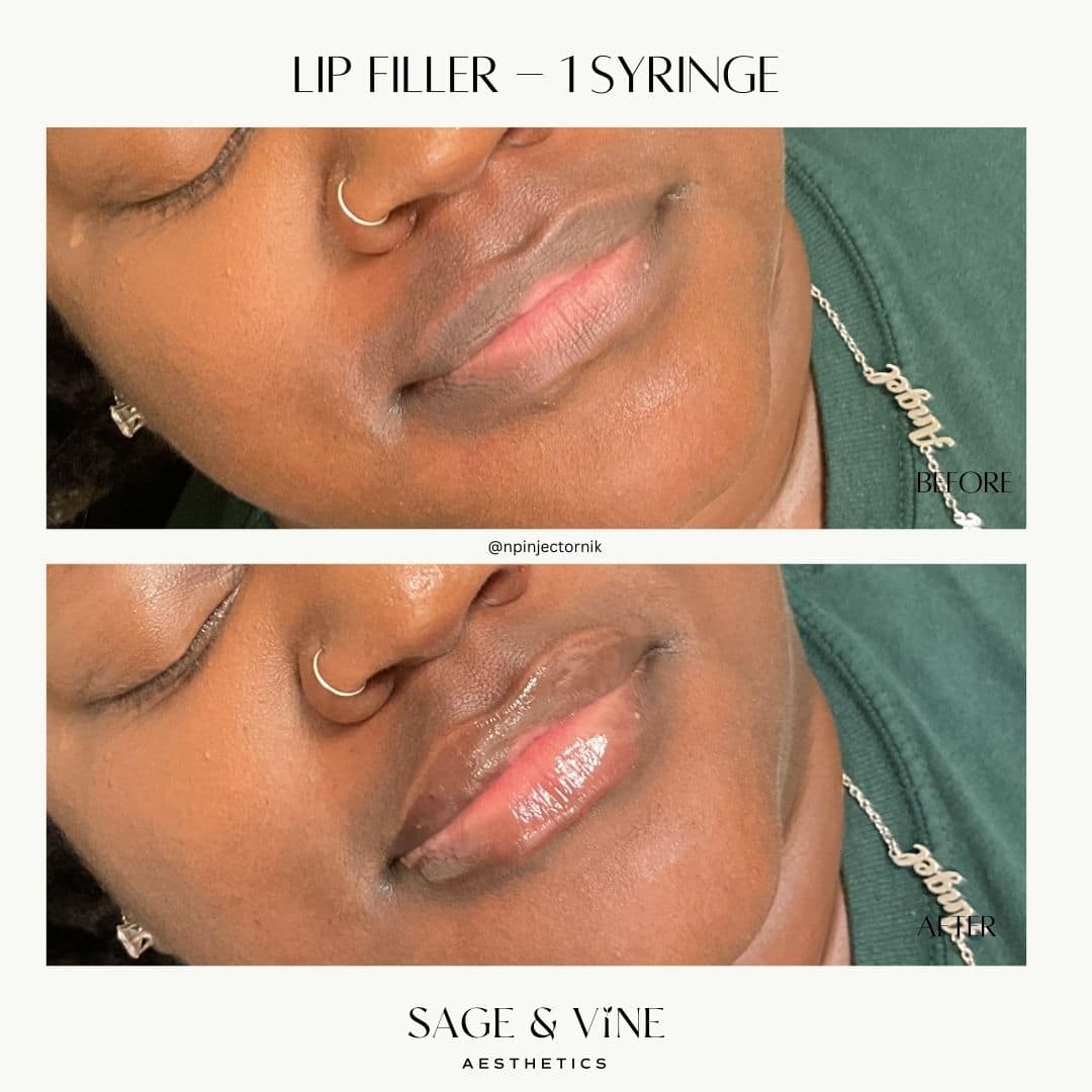 Before and After Image: Lip Filler – 1 Syringe - front