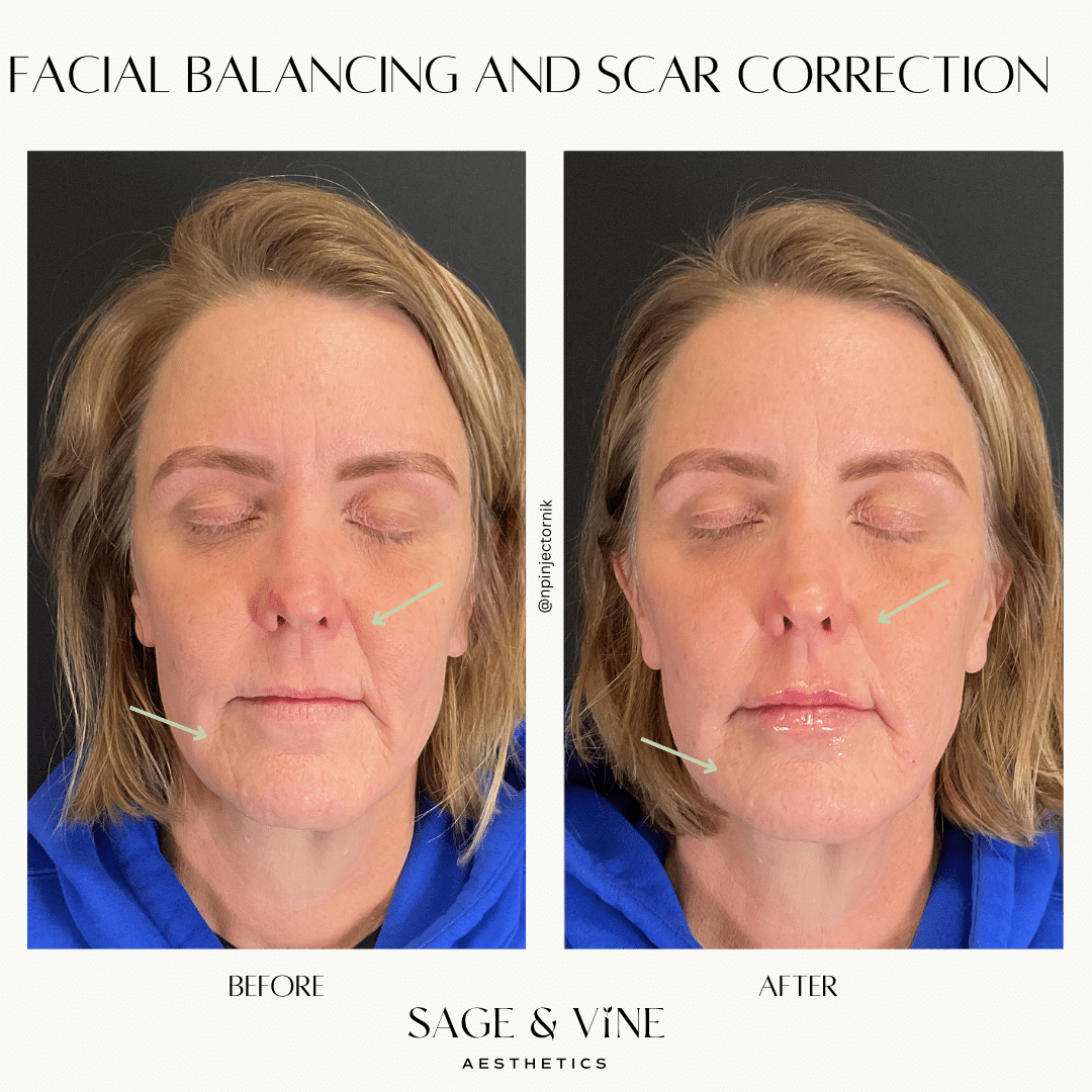Before and After Image: Facial Balancing and Scar Correction - front