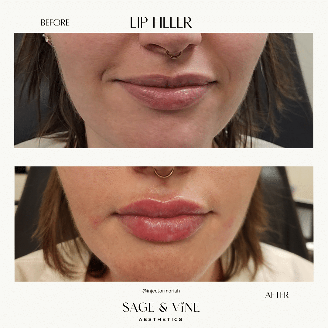 Before and After Image: Lip Filler - front