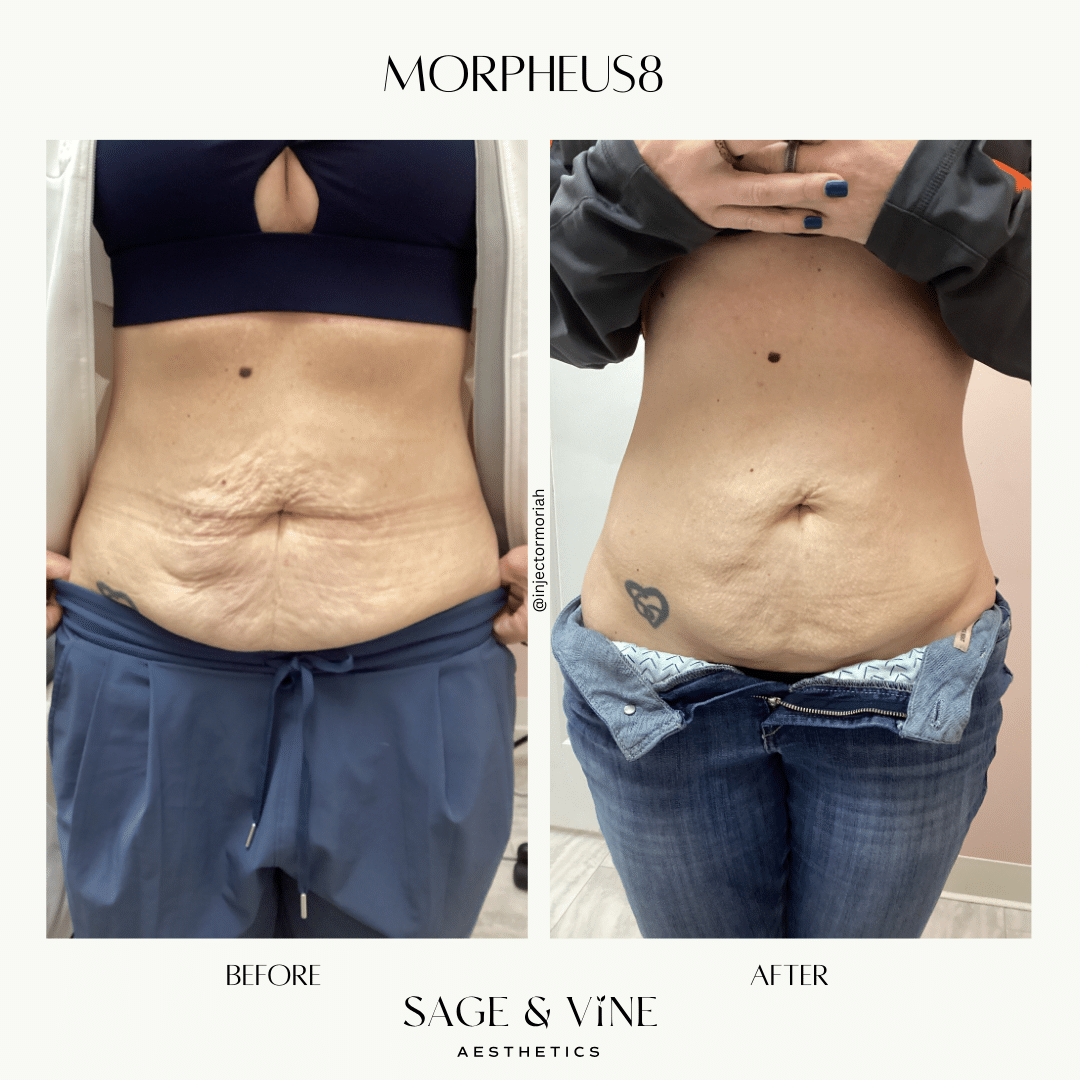 Before and After Image: Morpheus8 - front