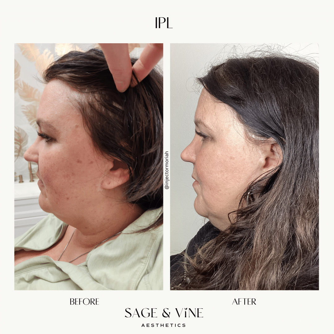 Before and After Image: IPL - front