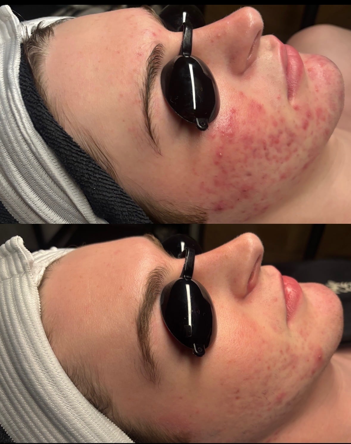 Before and After Image: Acne Bootcamp - front