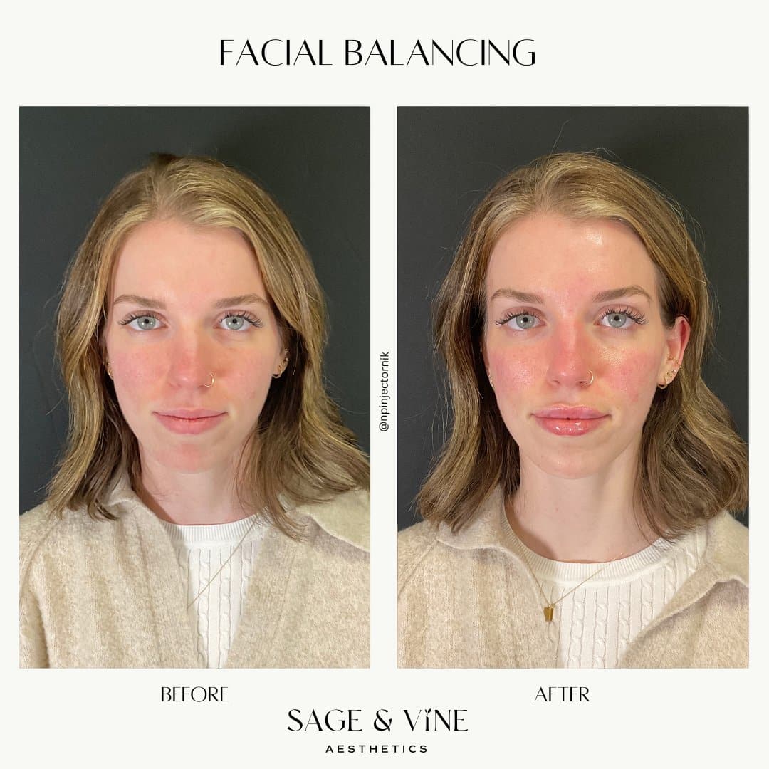 Before and After Image: Facial Balancing - front