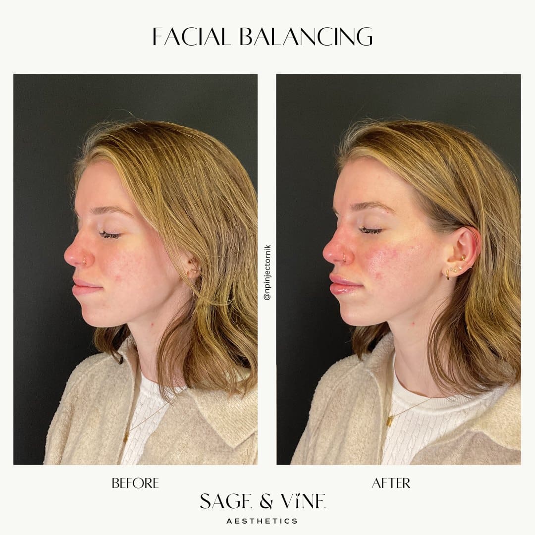 Before and After Image: Facial Balancing - left-side