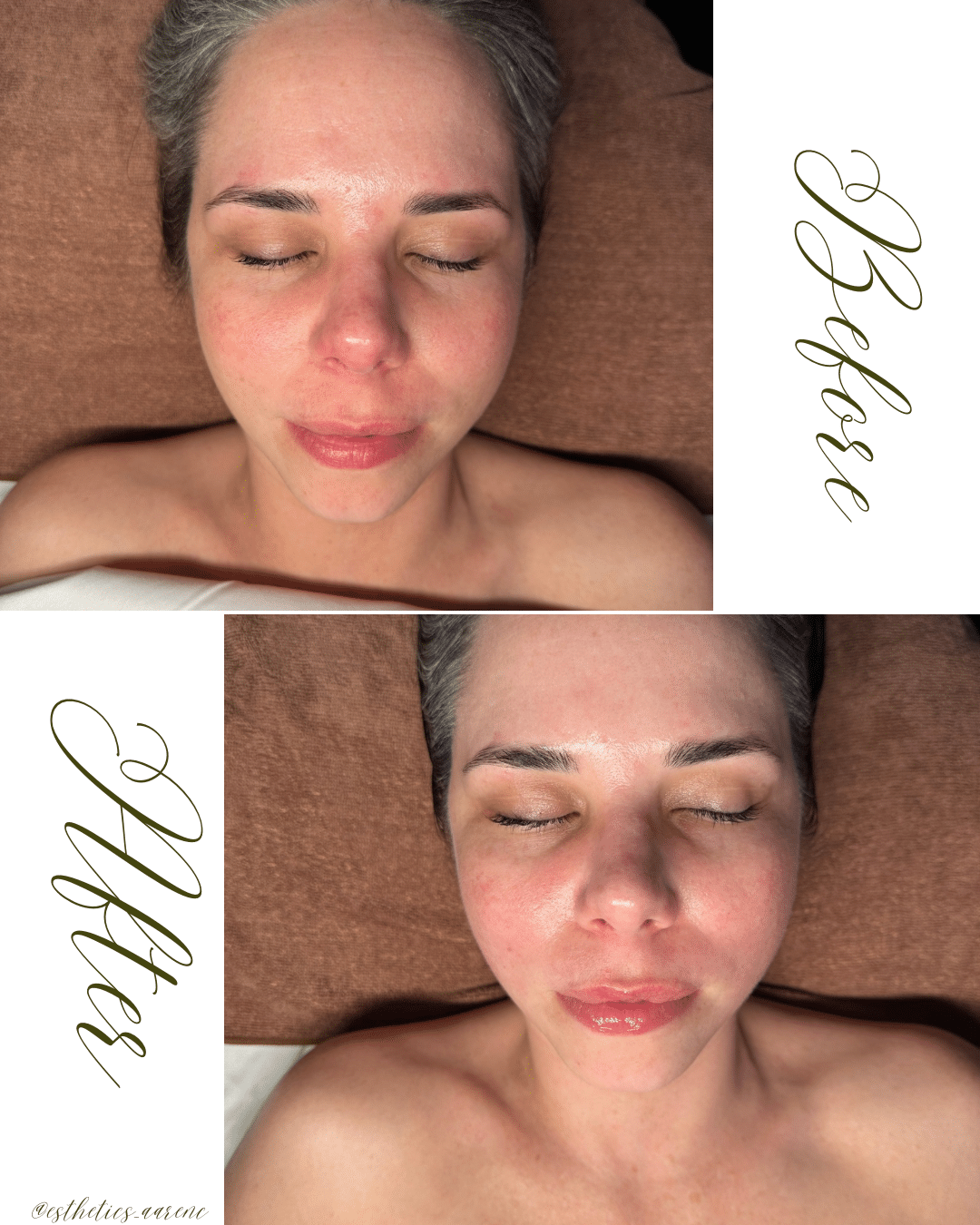 Before and After Image: Lymphatic Contour Facial - front