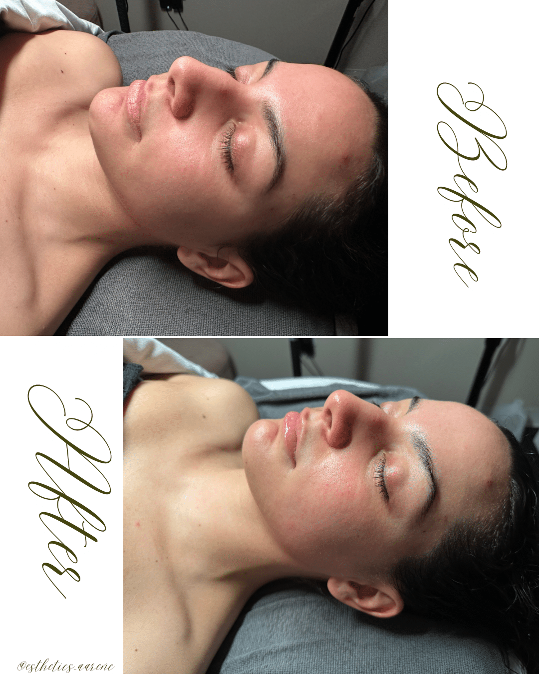 Before and After Image: Lymphatic Contour Facial - front