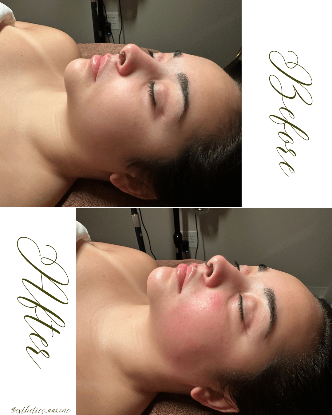 Before and After Image: Lymphatic Contour Facial - front
