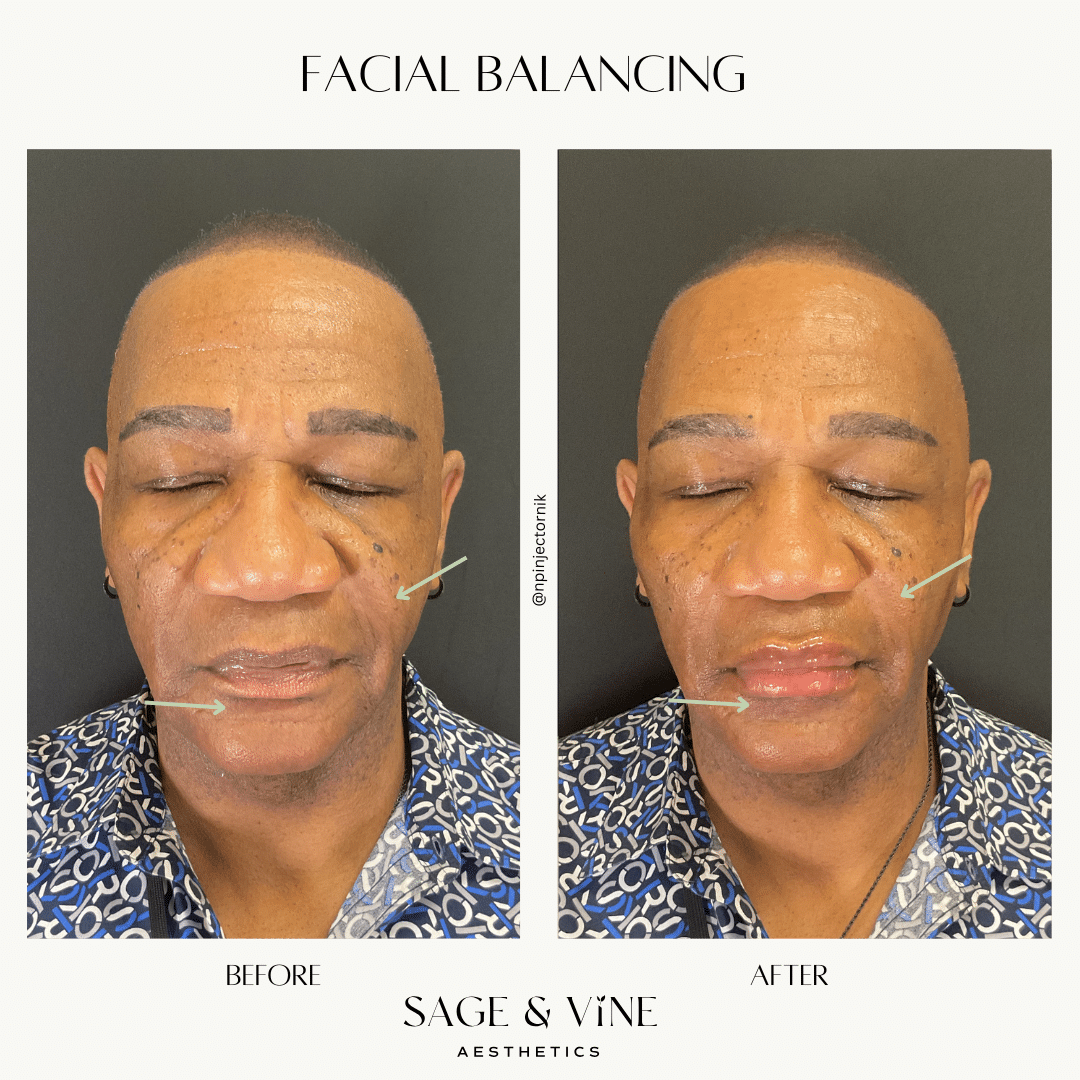 Before and After Image: Facial Balancing - front