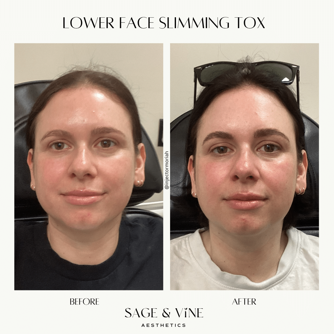 Before and After Image: Botox - front