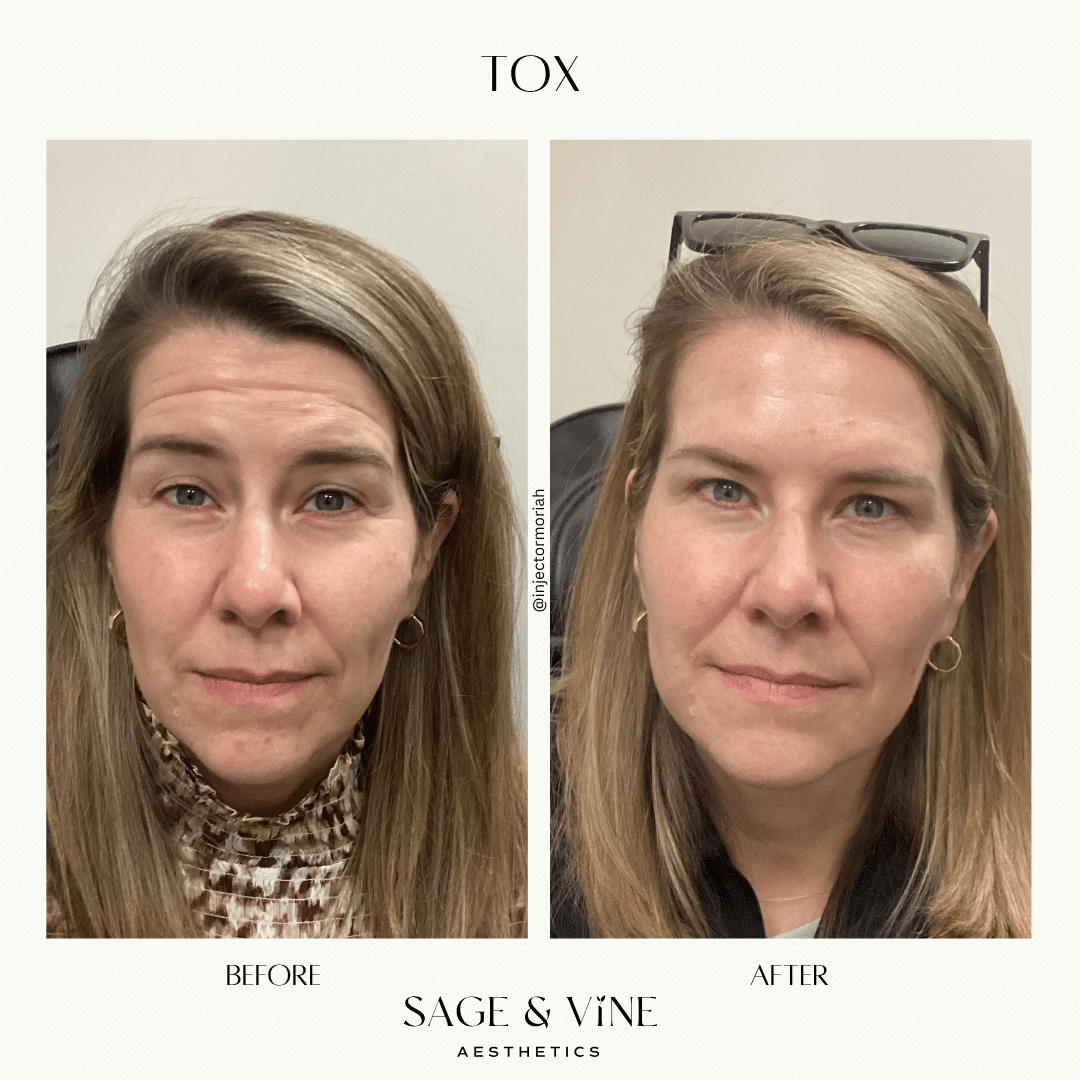 Before and After Image: Botox - front