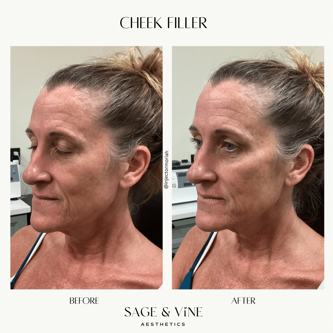 Before and After Image: Cheek Filler - front