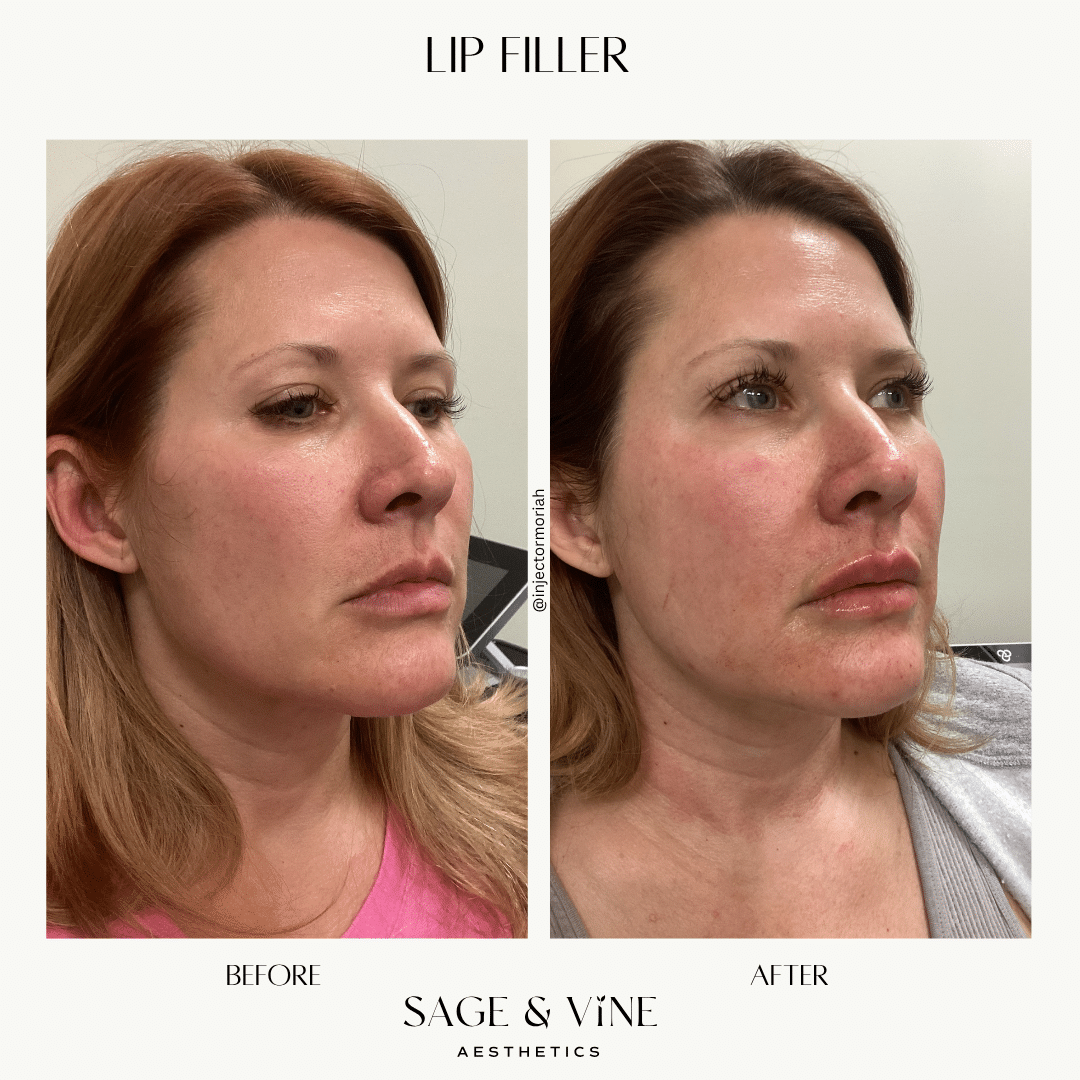 Before and After Image: Lip Filler - front