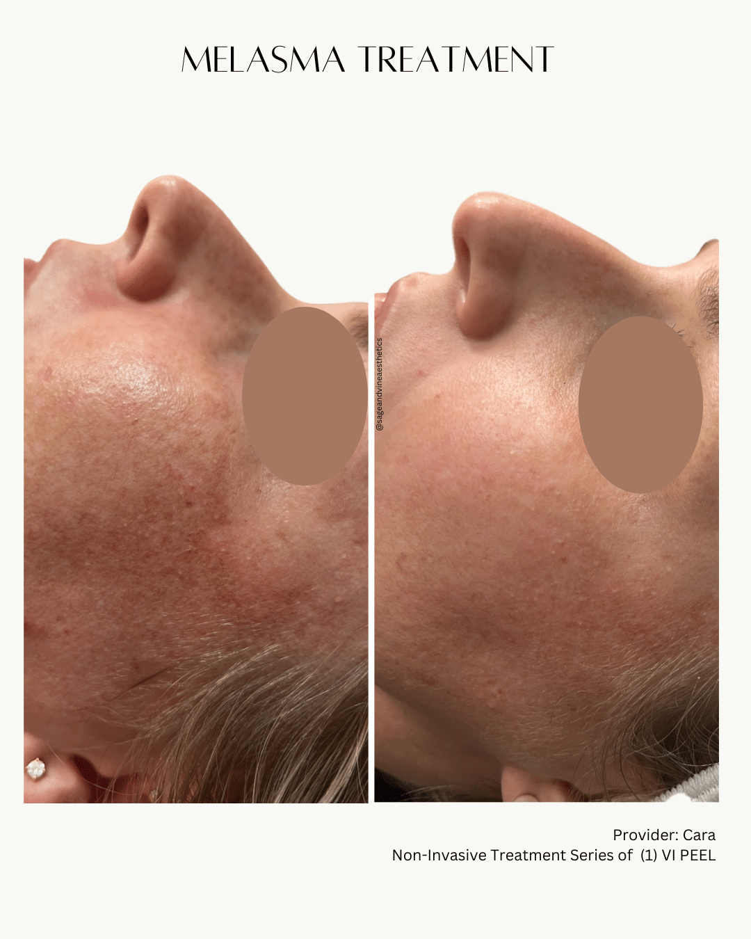 Before and After Image: Melasma Treatment - front