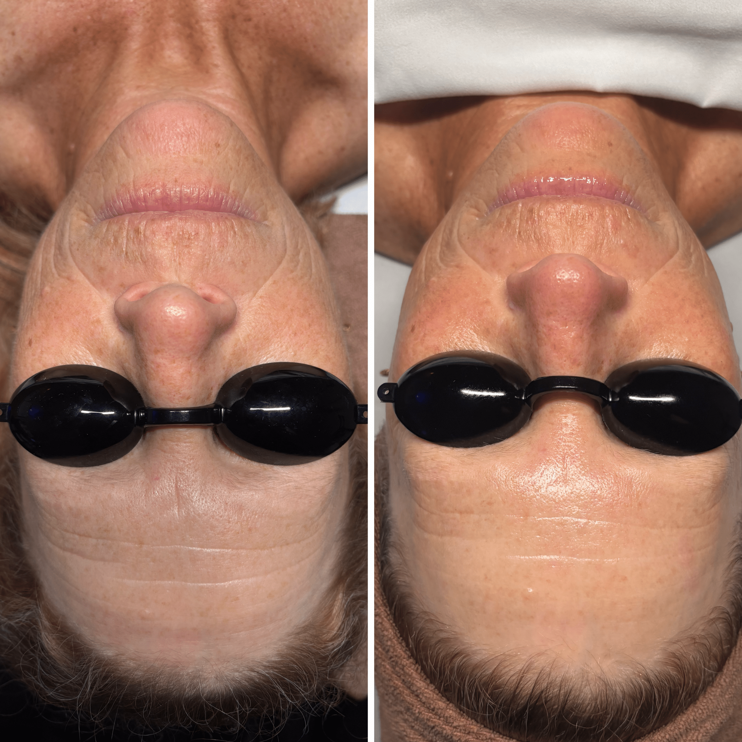 Before and After Image: Indulgence Facial - front