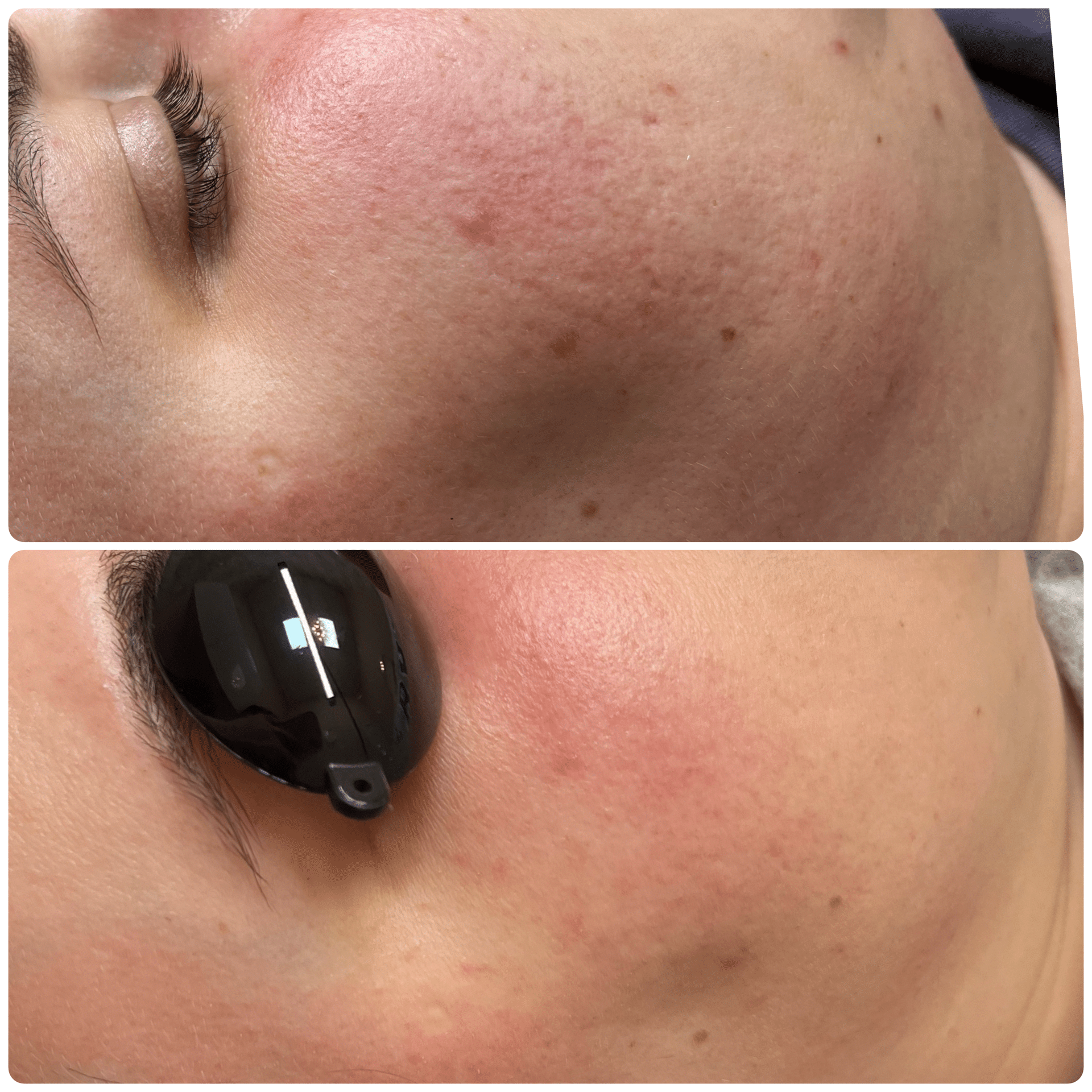 Before and After Image: Lumecca and Microneedling - front